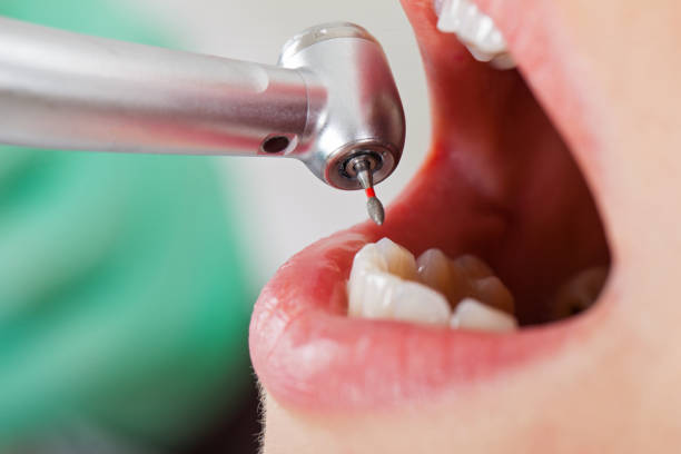 Best Emergency Dentist for Lost Fillings or Crowns in Svis, IL